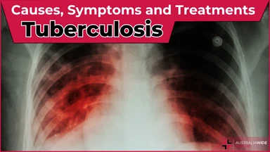 Tuberculosis article header – First Aid Article in Hunter Valley